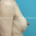 【乳頭縮小術014】シリコンインプラント豊胸術後の乳頭縮小術を行いました